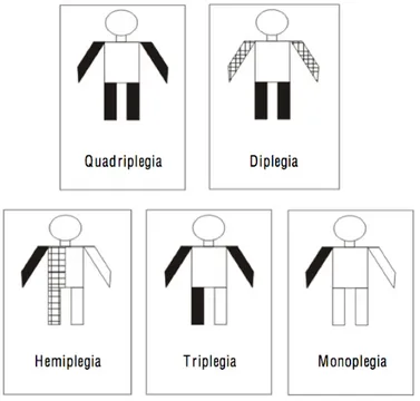 Paralisia Cerebral Mista Tipos De Paralisia Cerebral