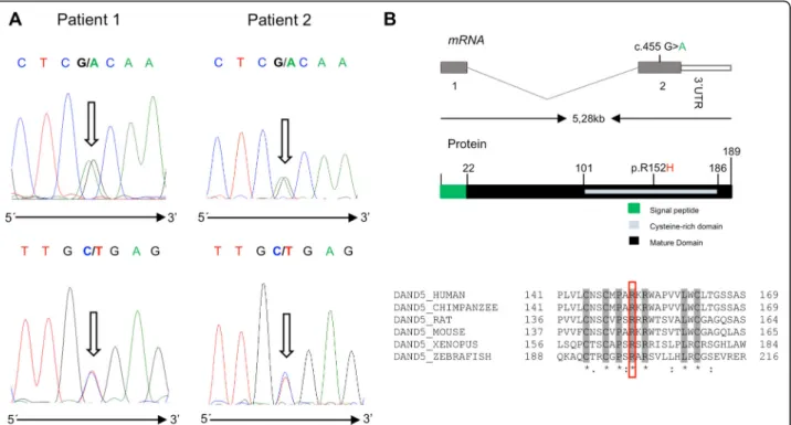 Fig. 1 a Forward and reverse DNA sequence chromatograms of patient 1 and 2 showing the c.455G &gt; A allelic variant (highlighted by arrows ).