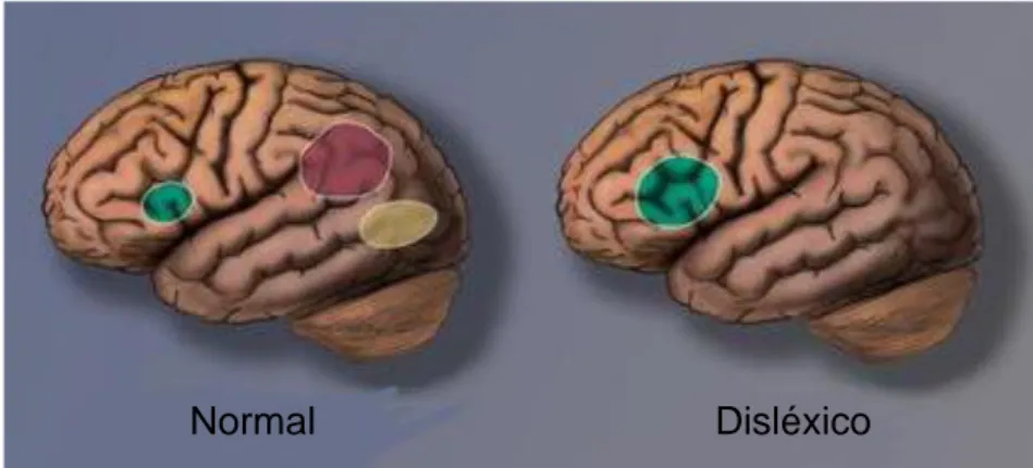Figura 7 A marca neural da Dislexia. (Fonte: Shaywitz, 2006:74). 