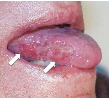 Figura 6- Pênfigos na face lateral da língua, com erosões e ulcerações (Adaptado de Nguyen &amp; 