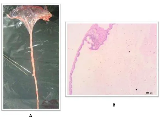 Figura 3:  A  -  Cisto  de  Ampola  uterina  e  Infundibular  de  fêmeas  suínas.  B  –  Microscopia de Cisto infundibular e oviduto: Delgada parede composta  por epitélio cilíndrico simples e conteúdo proteináceo 