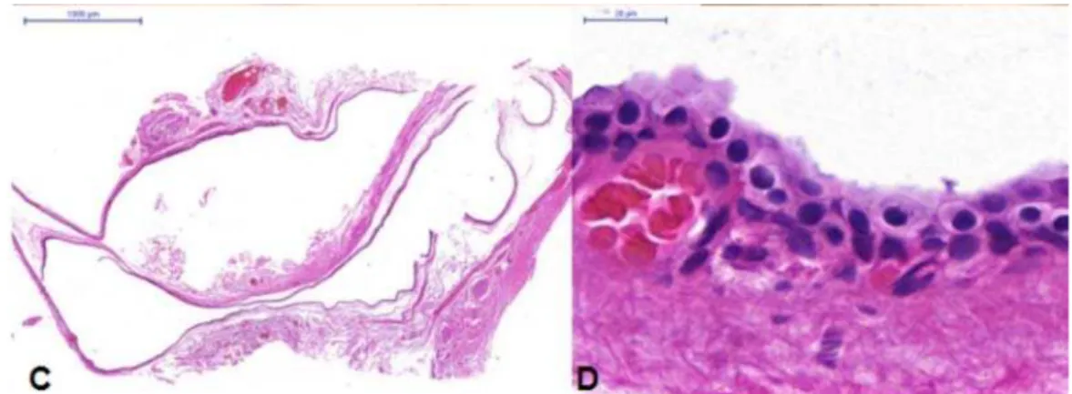 Figure 2. (A) Case 2—Ptosis of the right upper eyelid; (B) Cystic lesion with clear liquid  content among the fibers of the upper eyelid levator muscle; (C) Double layered cuboidal  cell lining, areas of transitional epithelium and positive apical glycocal