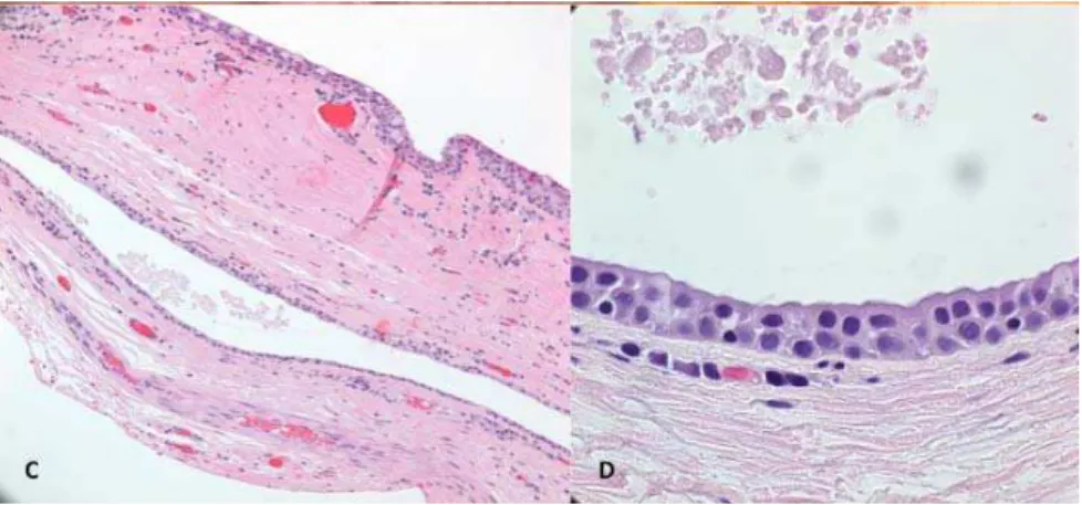 Figure 3.  (A) Case 3—Ptosis of the left upper eyelid; (B) Apocrine Cystic lesion with  bluish color; (C) Low magnification photomicrograph