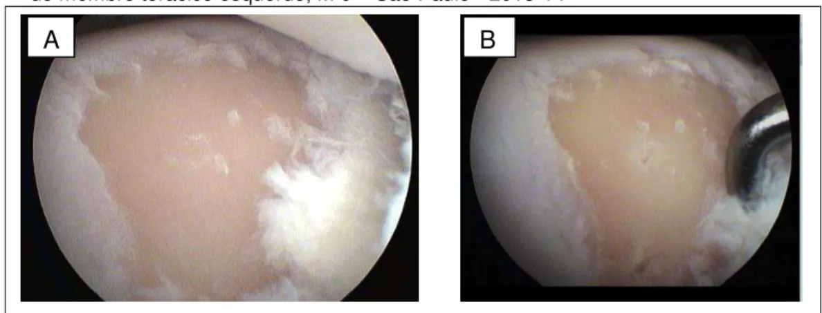 Figura 2 - Imagem artroscópica após a criação do defeito cartilagíneo no côndilo metacarpiano medial  do membro torácico esquerdo, M 0  –  São Paulo - 2013-14  