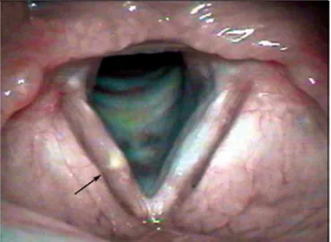 Figure 3. Bamboo nodule on the middle third of the right vocal fold (Arrow).