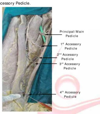 Fig.  5:   Sh ow in g  On e  Pr inci pal  / M ai n  pedicl e  an d  4 Accessory Pedicle.