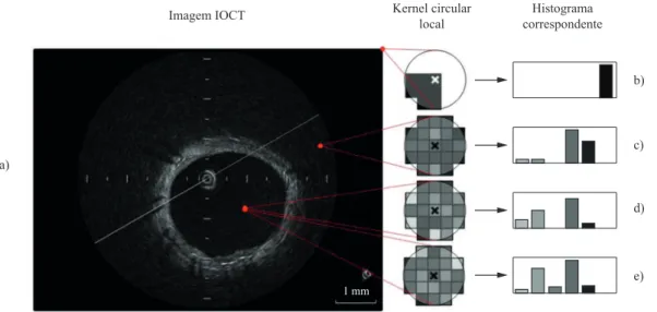 Figura 2.  a) Imagem característica de IOCT. (b), (c), (d) e (e) Ilustração do kernel circular local em diferentes posições, e seus respectivos  histogramas.