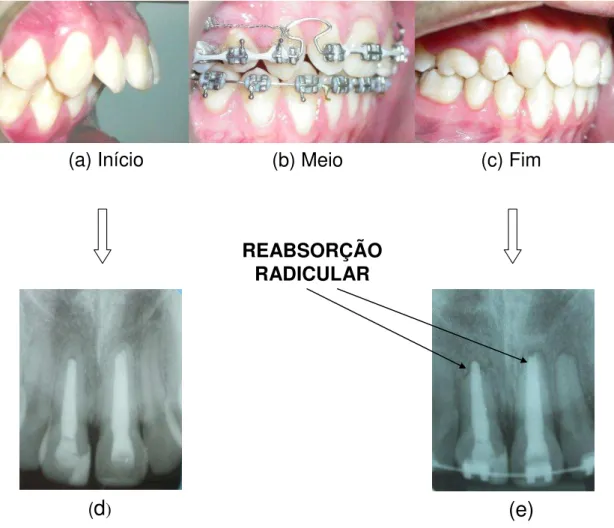 Figura 4 - Imagens de paciente em tratamento ortodôntico. Paciente no início do tratamento  ortodôntico (a), com o aparelho fixo (b), e com o resultado final (c)