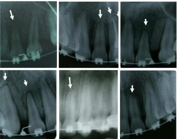 Figura 8 - Radiografias periapicais de pacientes da amostragem. Todas as radiografias são  de pacientes que apresentavam RRIE (setas brancas) de leve (perdas radiculares de até 2mm de  comprimento  radicular)  à  moderada  (perdas  radiculares  de  2mm  at