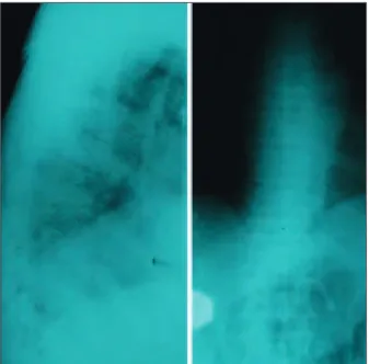 FIGURE 1.  Thoracic spine X-ray (AP and L direction), with pathological  changes on T6 and T7.