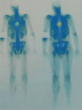 FIGURE 4. Scintigram of skeleton with clear collection of radiopharma- radiopharma-ceuticals in region of T6 and T7.