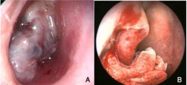 Fig 1:  Endoscopic view of JNA before use of  the tampon (A) and after pushing the tumor to  the  posterior  by  applying  pressure  with  the  tampon (B)