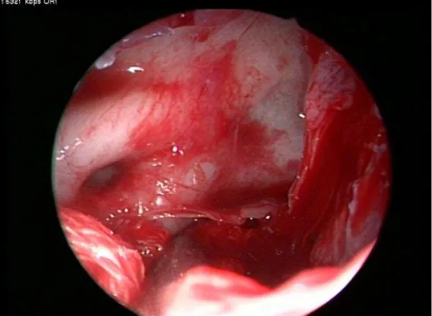 Fig 2: Endoscopic view of the sphenoid sinus  while the tumor is pushed inferiorly by tampon  in a bloodless field