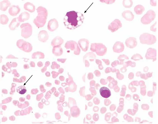 Figure 1. The top image shows a Mott cell. The bottom left image shows a similar Mott cell packed with spherical cytoplasmic  inclusions