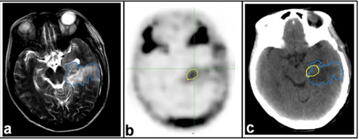 Fig 3. MRI and 18 F-FLT PET images for a patient with glioblastoma (GBM). Images were taken 21 days post-operatively and 2 days before radiotherapy.