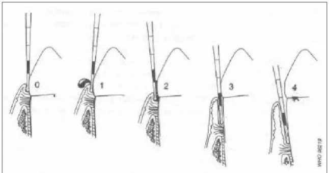 Figura 4.1- Exemplos da codificação do ICP e posição da sonda periodontal (figura do livro Levantamentos básicos                      em saúde bucal, OMS) 