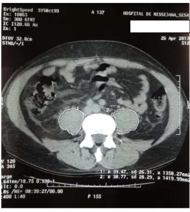 Figura 6 - Digitalização da imagem da área de secção transversal do músculo psoas maior