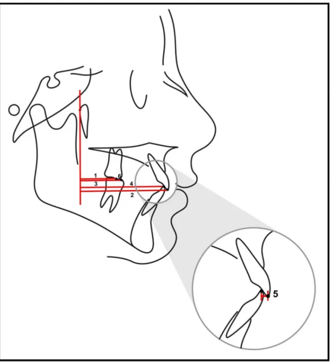 Figura 8 - Grandezas lineares dentárias no sentido antero-posterior. 