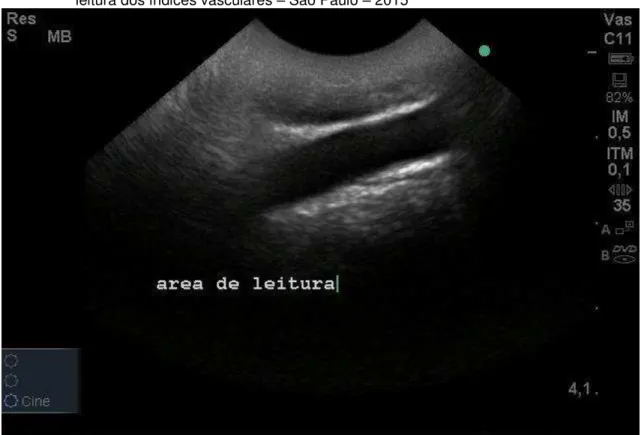 Figura  3  -  Imagem  ultrassonográfica  da  artéria  digital dorsal  comum,  evidenciando  o local de  leitura dos índices vasculares  –  São Paulo  –  2015 