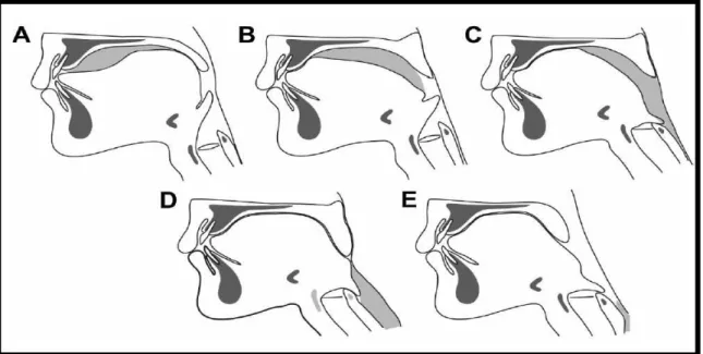 Figura 8 - Desenho ilustrativo da deglutição. (A) O bolo alimentar encontra-se entre a superfície anterior  da língua e o palato duro, final da fase preparatória oral