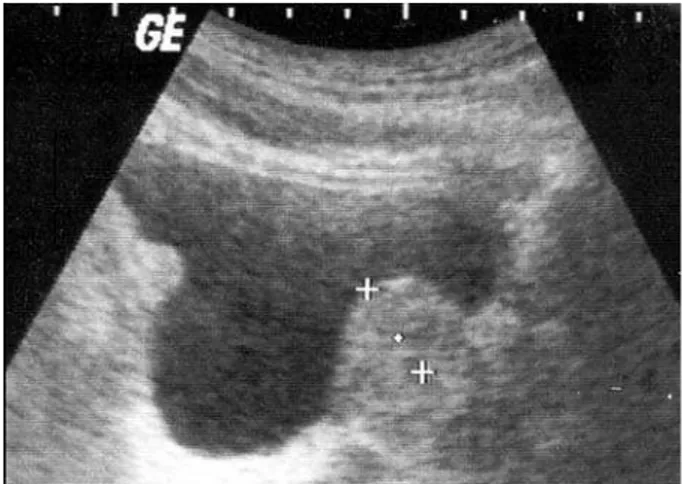 Figure 1 –  6DJLWWDOYLHZVRIEODGGHUDQGSURVWDWHXVLQJWUDQVDE - -dominal ultrasonography. Vertical distance from tip of  protru-sion to base of bladder is the intravesical prostatic protruprotru-sion  measurement.