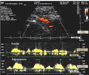 Figura 4.2.2  – A imagem superior representa o fluxo a cor da DA distal por EDTT. Imagem inferior  representa o espectro Doppler pulsado da DA distal em basal e durante hiperemia com adenosina em infusão  na concentração de 140µg/kg/min