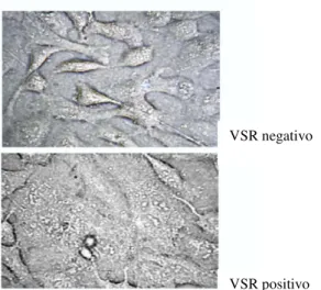Figura 8: Cultura de células de epitélio nasal após infecção por VSR,  com formação de sincícios (Bitko 2004)
