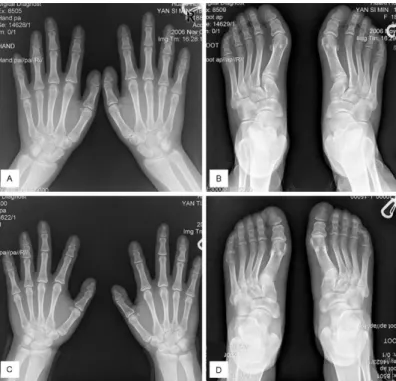 Figura 8 – Radiografia das mãos e pés, mostra dedos pequenos de uma filha (A e B) e  da sua mãe (C e D)