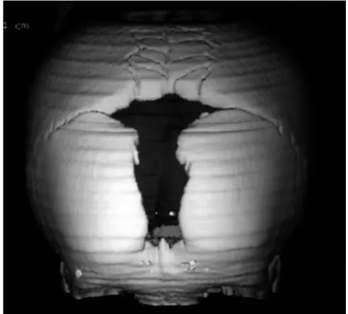 Figura 10  –  Tomografia Computorizada 3D, mostra a fontanela aberta e múltiplos ossos  suturais