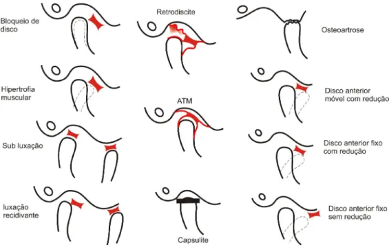 Figura 2 - Representação esquemática da Desordem Temporomandibular