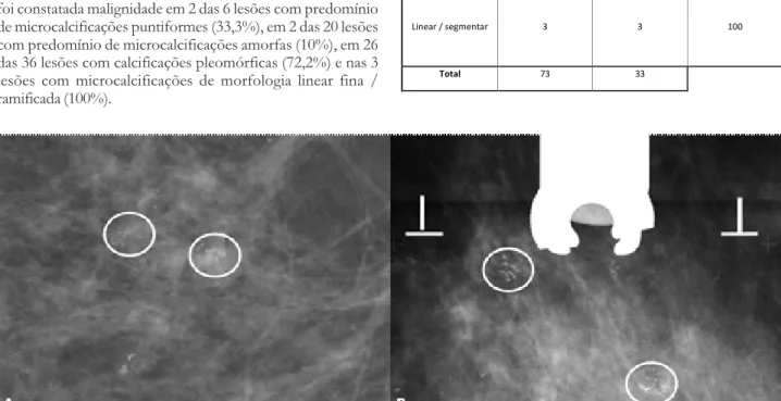 Fig. 4 - Mulher, 61 anos. Morfologia benigna. Imagens mamográficas obtidas sem (A) e após compressão (B) revelam vários agrupamentos de