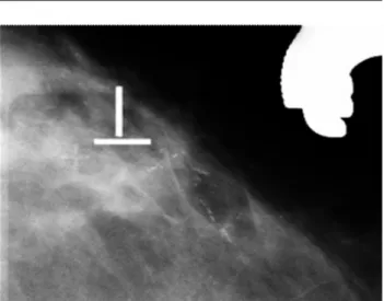 Fig. 5 - Mulher, 48 anos. Morfologia amorfa. Imagem mamográfica obtida após compressão demonstra microcalcificações com morfologia algo heterogénea dispersas por uma pequena área de tecido mamário
