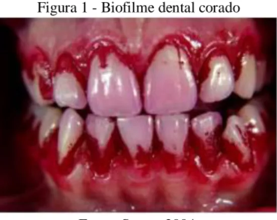 Figura 1 - Biofilme dental corado 