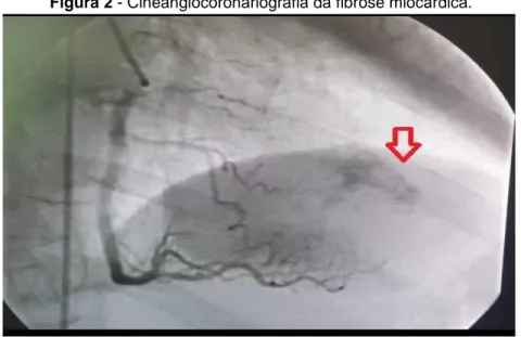 Figura 2 - Cineangiocoronariografia da fibrose miocárdica. 