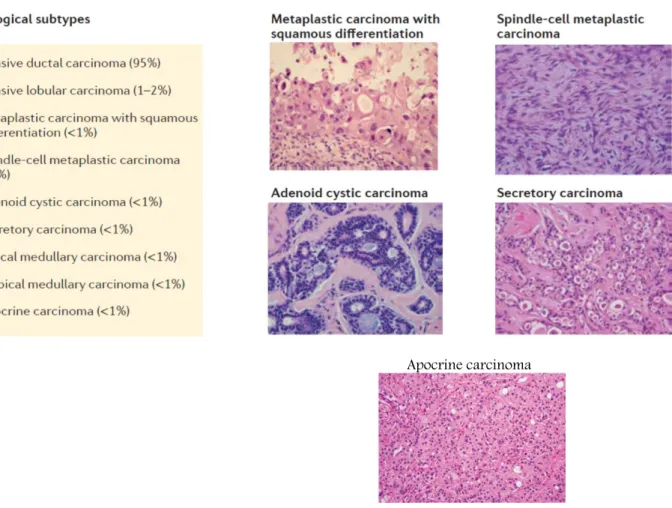 Figura  15.  Características  histológicas  de  um  TNBC  com  positividade  para  o  recetor  de  androgénio  luminal  (LAR)  A-  Com  baixa  ampliação,  observam-se  nichos  infiltrativos  e  cordões  eosinofílicos  de  células  tumorais  rodeados  por  