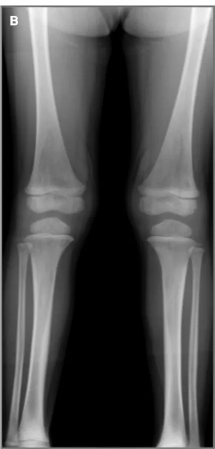 FIGuRe 2a. Signs of periostitis of the lower limb (marked with arrow) in November 2007