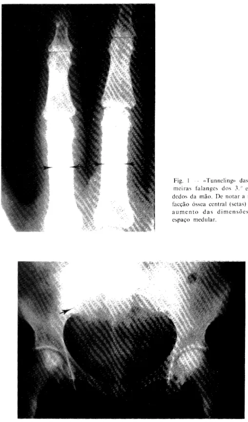 Fig. 2 «Quistos» ósseos (osteolise) das duas cabeças femurais. Sacroileíte à direita (seta