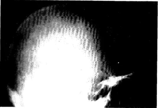 Fig. 7 — Crânio de perfil com lesões granulares de osteosclerose e osteopenia, classicamente  chamado em «sal e pimenta»