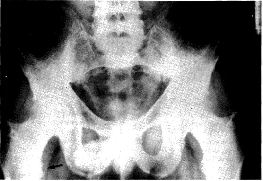 Fig. 11 — Sacroiliaca fantasma à direita e reabsorção dos troquiteres femurais (seta)