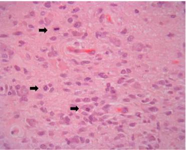 Figura 8 – Astrocitoma anaplásico. Tumor de celularidade aumentada cujos elementos astrocitários são munidos  de núcleos medianamente pleomórficos e hipercromáticos e apresentam  índice mitótico aumentado (setas  a  negro)