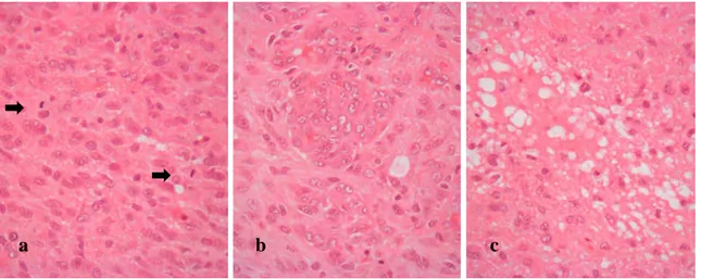 Figura 9  –  Glioblastoma.  A)  índice mitótico aumentado  (seta a negro); b) alterações da microvascularização  tumoral com proliferação endotelial (ao centro)