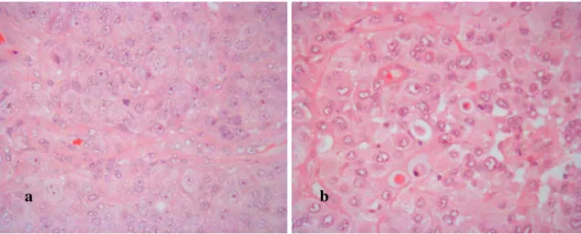 Figura 10 – Tumores metastáticos. a) adenocarcinoma do pulmão. b) carcinoma da mama. Ampliação 400x