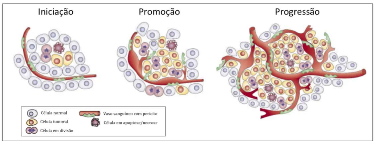 Figura   4|   Etapas   da   patogênese   tumoral   e   seu   microambiente.   Na   fase   inicial,   as   células    sofrem    mudanças    no    tamanho    e    forma    dos    núcleos,    bem    como    um    aumento    expressivo    devido    à    desreg