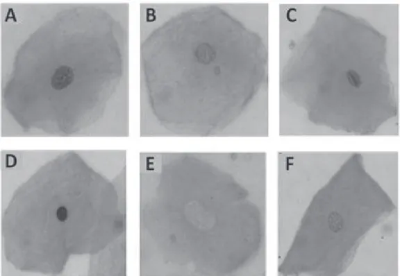 Figure 1. Photomicrographs of cells exfoliated from the oral mucosa (stained using the  Felgen/Fast  green method) exhibiting normal nuclear morphology: (A) a micronucleus (B); condensed chromatin ©; 