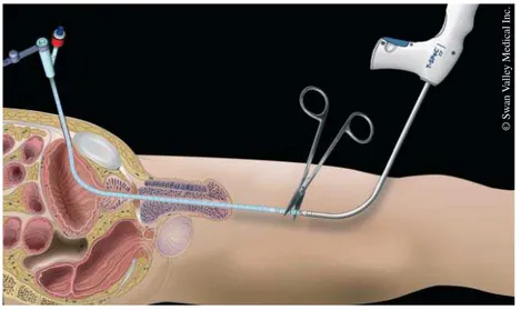 Abbildung 5: Das Instrument mit dem konnektierten Katheter wird durch die Harnröhre gezogen, an der davor vor-