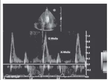 Abbildung 1:  Apikaler Vierkammerblick: Dilatation aller vier Herzhöhlen. LA = linker Vorhof, LV = linker Ventrikel, RA = rechter Vorhof, RV = rechter Ventrikel