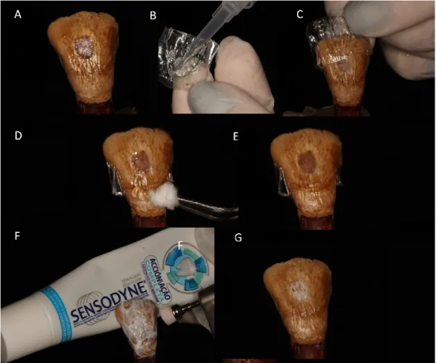 Figura 3: Protocolo de Branqueamento Dentário 