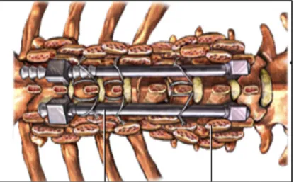 Figura  1.10  –  Detalhe  da  instrumentação  utilizada,  por  forma  a  endireitar  a  curvatura  da  coluna  vertebral  numa cirurgia de escoliose (Simon, 2012)