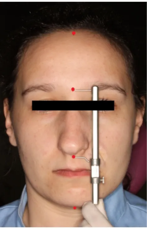 Figura 2. Divisão da face nos  3 terços e medição dos mesmos com  a ajuda de um paquímetro