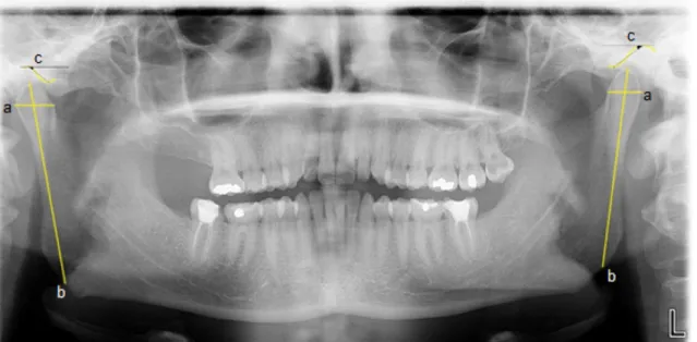 Figura 11 - Mensurações feitas na radiografia panorâmica (a: tamanho do côndilo; b: altura mandibular; 